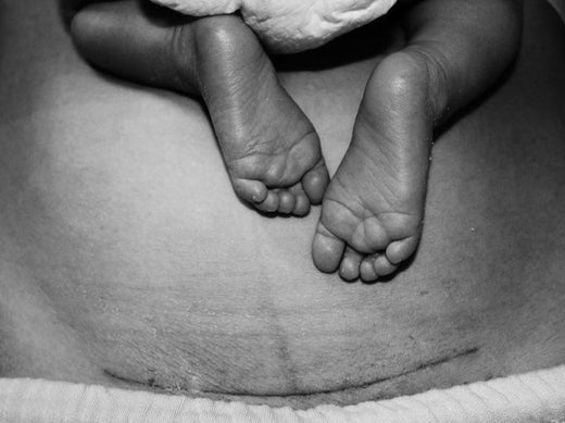 Top Tips for Caesarean Delivery and Recovery | Hotmilk - Hotmilk Lingerie